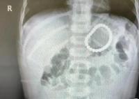 2岁幼童误吞28颗磁力珠 CT照片曝光实在是太吓人了