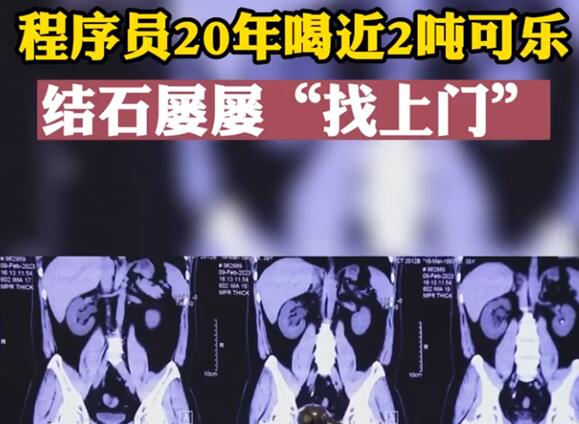 程序员20年喝近2吨可乐屡患结石 到底是什么情况?