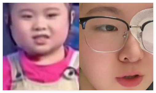 知名童星“秦虹一枝花”右眼失明 原因竟是这样太无奈了